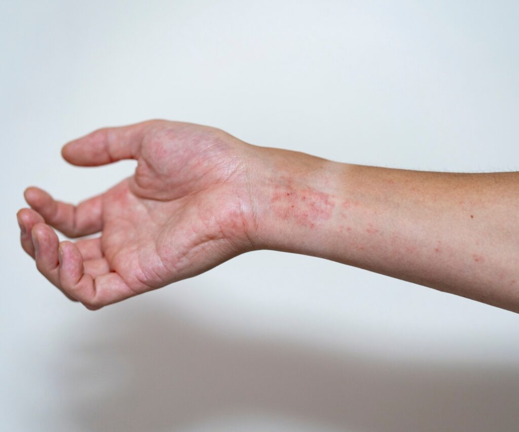 Underarm och handled med röda utslag.
